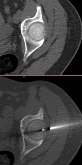 Imagine a ablației cu radiofrecvență pentru osteoid osteom