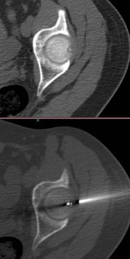 Osteoid Osteoma Ablation: Radiofrequency vs. Microwave Ablation OSTEOID OSTEOMA ABLASYONU Image of osteoid osteoma ablation procedure