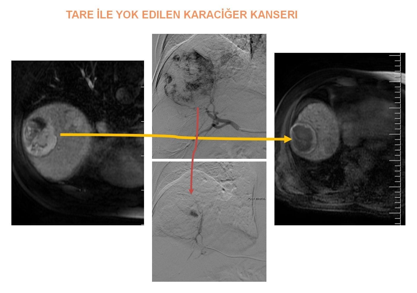 Tratamentul cu radioembolizare TARE KARACIGER KANSERI TARE KARACİĞER KANSERİ işlemi öncesi sonrası