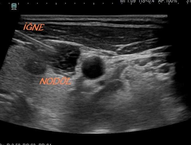 What is a Thyroid Biopsy? How is it Performed? Does It Have Any Risks? TIROID BIYOPSI Thyroid biopsy procedure image