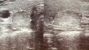 At What Size Does a Thyroid Nodule Become Dangerous? Tiroid Nodulu