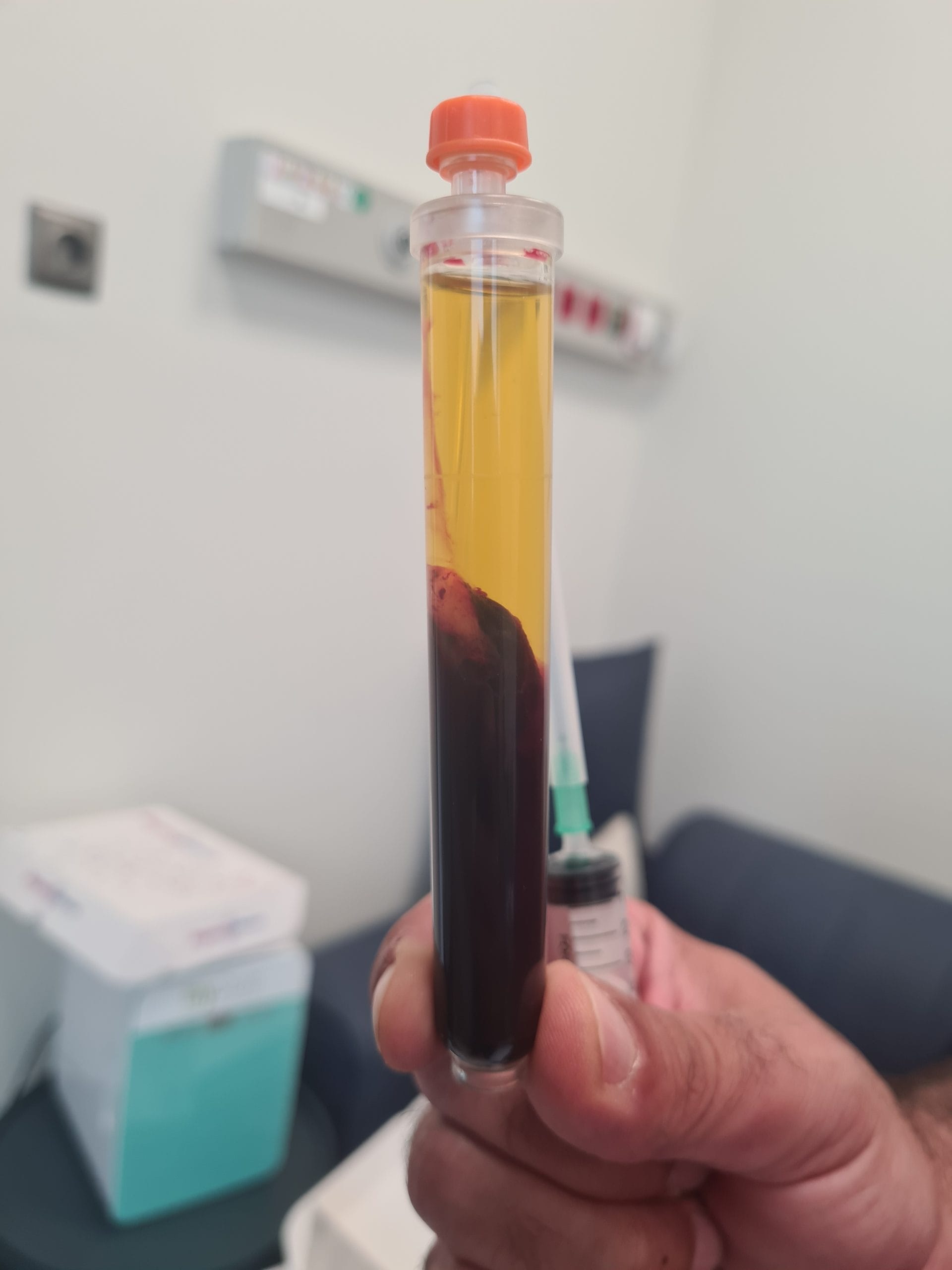 Tratamentul durerii de genunchi cu PRP diz prp 1 scaled tub pregătit pentru PRP la genunchi