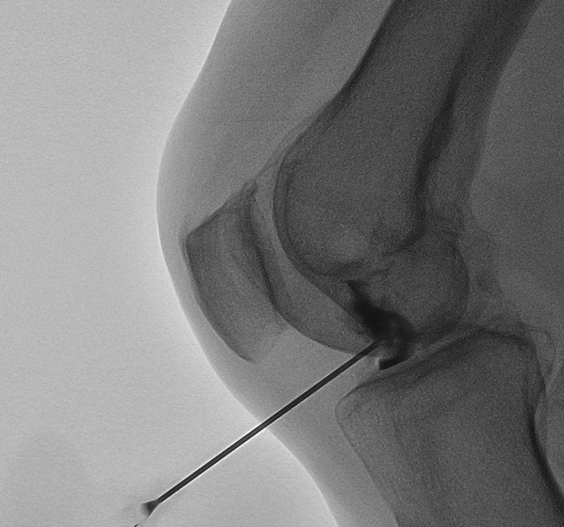 Tratamentul durerii de genunchi cu PRP diz prp 2 imagine cu injectarea PRP la genunchi