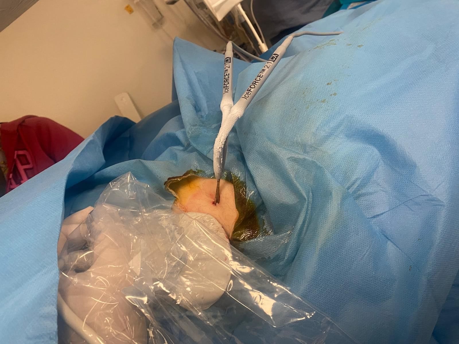 Kryoablation (Kälteablation) kryo1 e1722082134525 Kryoablation Verfahren Bild