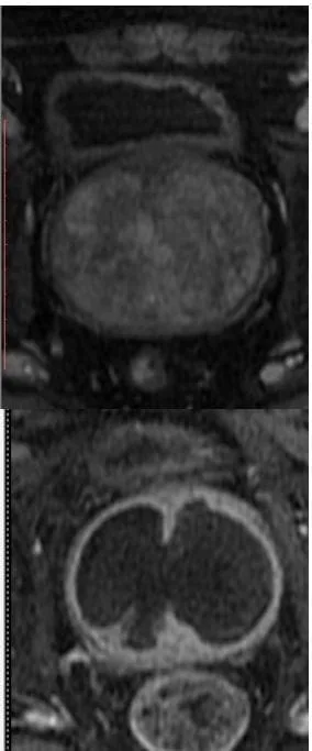 Prostate Artery Embolization (PAE): Procedure, Benefits, Risks and Recovery prostat embolizasyonu oncesi sonrasi goruntusu Before and after image of prostate embolization