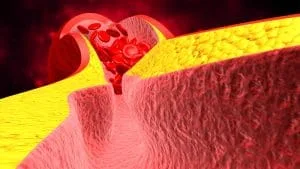 Blutgerinnung (Thrombose) Kan Pihtilasmasi Tromboz Neden Olur Belirtileri Nelerdir