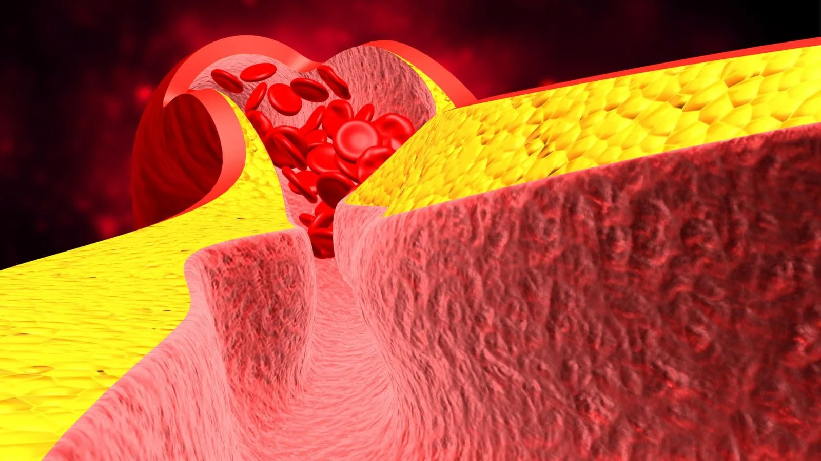 Blutgerinnung (Thrombose) Kan Pihtilasmasi Tromboz Neden Olur Belirtileri Nelerdir