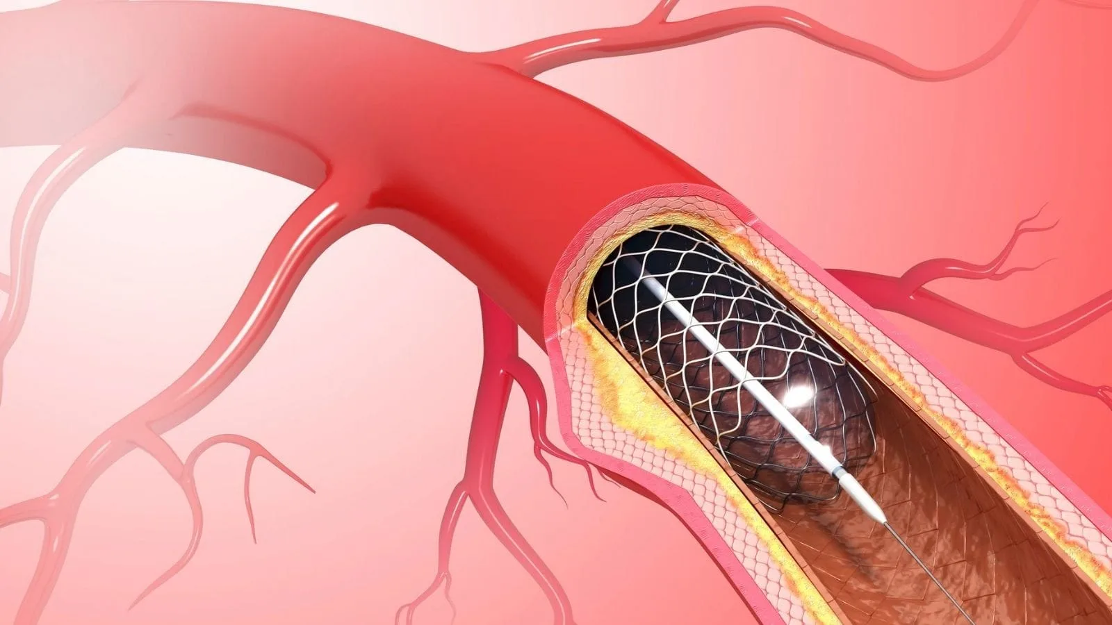 Stent Stent Nedir Stent Nasil Takilir