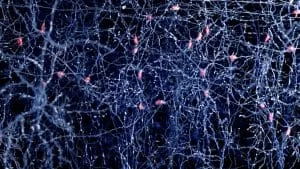 Fistulă Arteriovenoasă Durală (FAVD) Dural Arteriovenoz Fistul DAVF