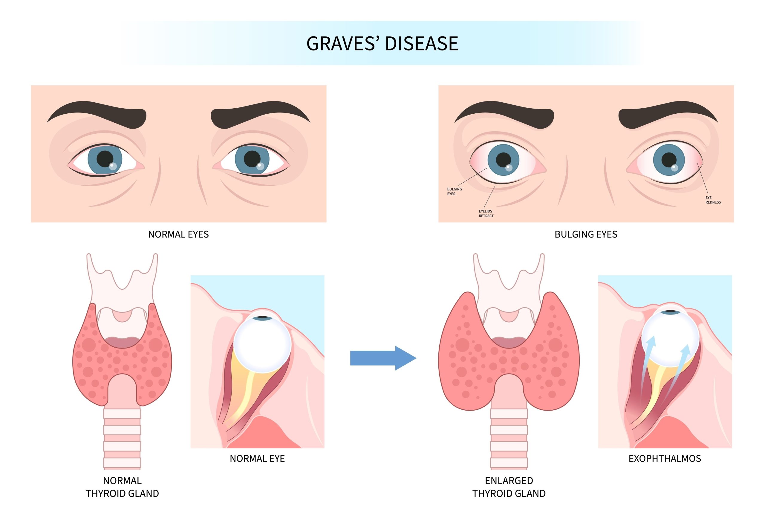 Graves Hastalığı Nedir? Graves Hastalığı Belirtileri & Beslenme Notları Graves Hastaligi scaled Graves Hastalığı görüntüsü