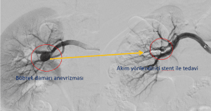 Böbrek damarı anevrizmasının akım yönlendirici stent ile tedavisi
