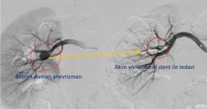Böbrek damarı anevrizmasının akım yönlendirici stent ile tedavisi