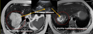Dev Karaciğer Hemanjiom Mikrodalga Ablasyon
