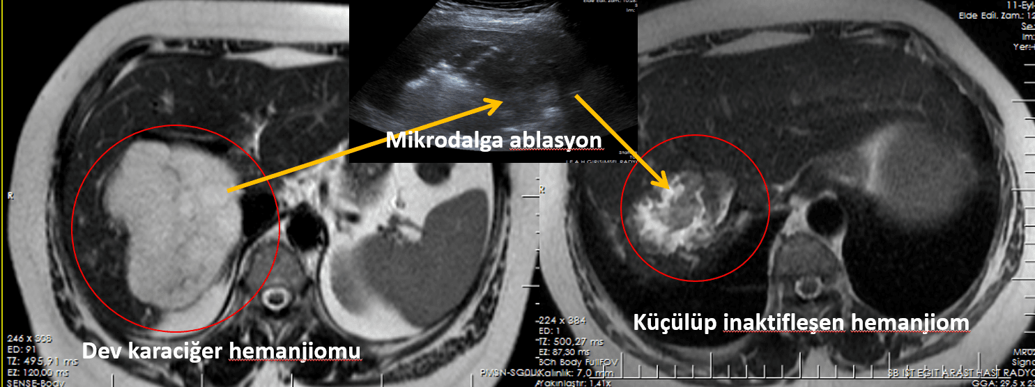 Dev Karaciğer Hemanjiom Mikrodalga Ablasyon Dev Karaciger Hemanjiom Mikrodalga Ablasyon Dev Karaciğer Hemanjiom Mikrodalga Ablasyon
