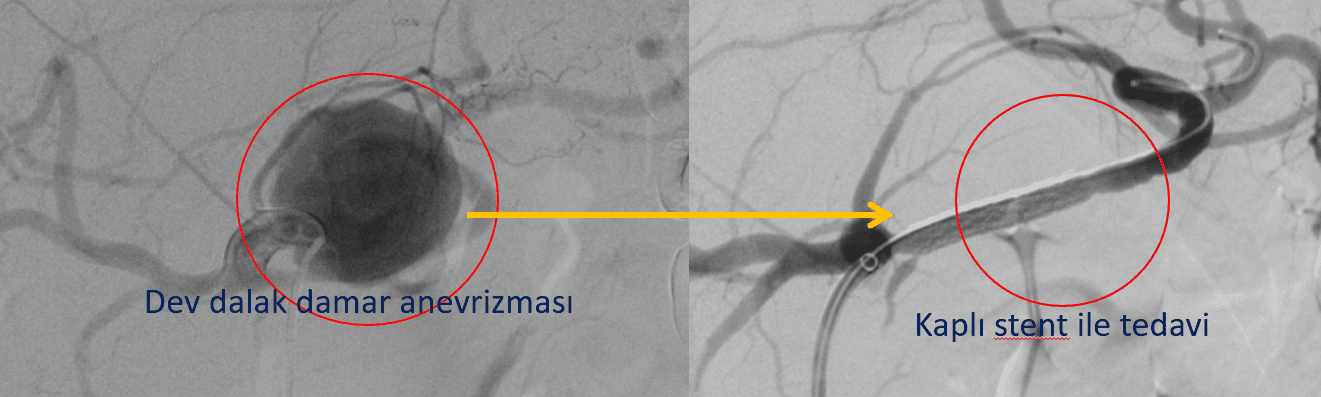 Dev dalak damar anevrizması kaplı stent ile tedavisi Dev dalak damar anevrizmasi kapli stent ile tedavisi Dev dalak damar anevrizması kaplı stent ile tedavisi