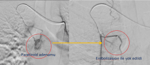 PARATİROİD ADENOM EMBOLİZASYONU SONUCU