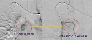 PARATİROİD ADENOM EMBOLİZASYONU SONUCU