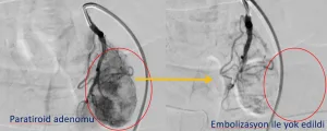 Sol akciğer komşuğuna gizlenmiş paratiroid adenomu