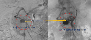 Bağırsak dalak anevrizması embolizasyonu