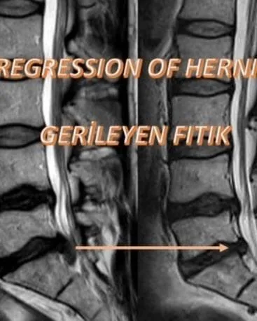 Bel fıtığı disk içi radyofrekans tedavisi sonucu bel fitigi disk ici radyofrekans tedavisi oncesi sonrasi 2 Bel fıtığı disk içi radyofrekans tedavisi sonucu bel fitigi disk ici radyofrekans tedavisi oncesi sonrasi 2