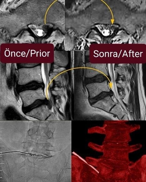 Bel fıtığı disk içi radyofrekans tedavisi sonucu bel fitigi disk ici radyofrekans tedavisi oncesi sonrasi