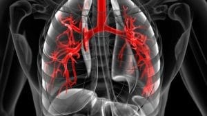 Embolizarea arterei bronșice Bronsiyal Arter Embolizasyonu