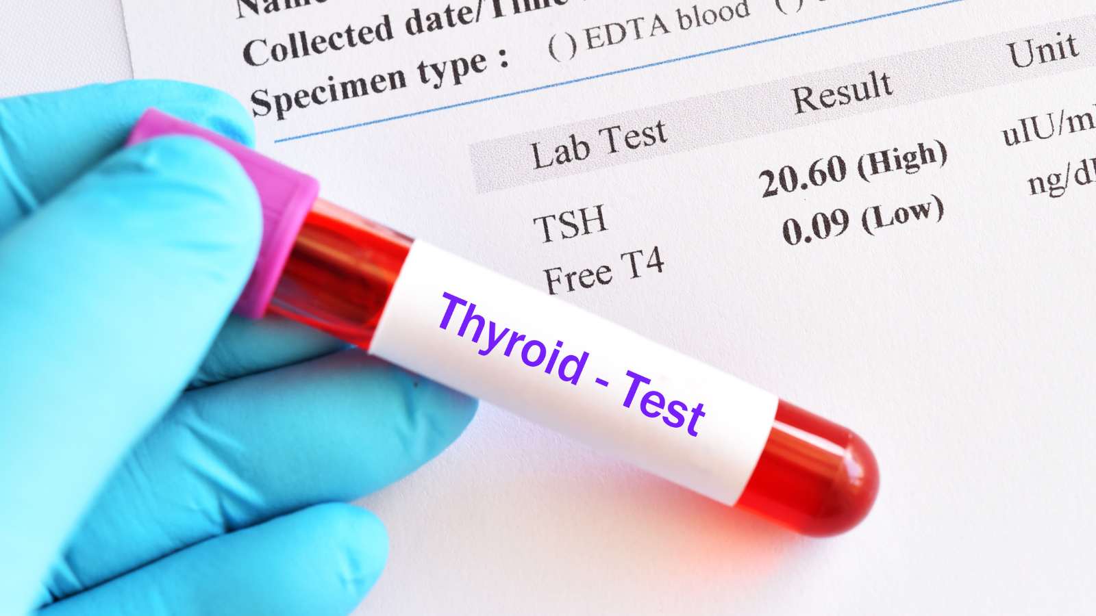 What Is Hypothyroidism? What Are the Symptoms of Hypothyroidism? Hipotiroidi What Is Hypothyroidism? What Are the Symptoms of Hypothyroidism? Hipotiroidi
