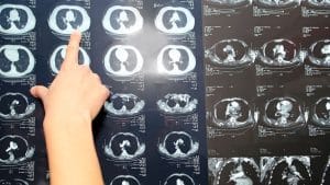 Embolizarea arterei meningiene medii în hemoragia subdurală cronică Kronik Subdural Kanamada Orta Meningeal Arter Embolizasyonu