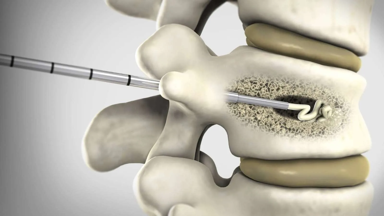 Kifoplasti ve Vertebroplasti Nedir? Ameliyatsız Tedavi Yöntemleri Vertebroplasti Kifoplasti