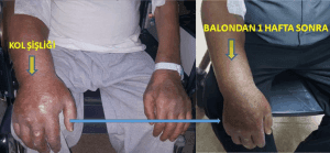 Santral ven oklüzyonu: Balon tedavisi