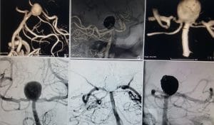 Y stent eşlikli kapalı anevrizma tedavisi