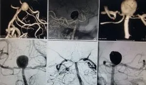 Y stent eşlikli kapalı anevrizma tedavisi