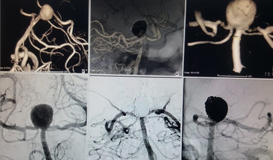 Y stent eşlikli kapalı anevrizma tedavisi y stent Y stent eşlikli kapalı anevrizma tedavisi