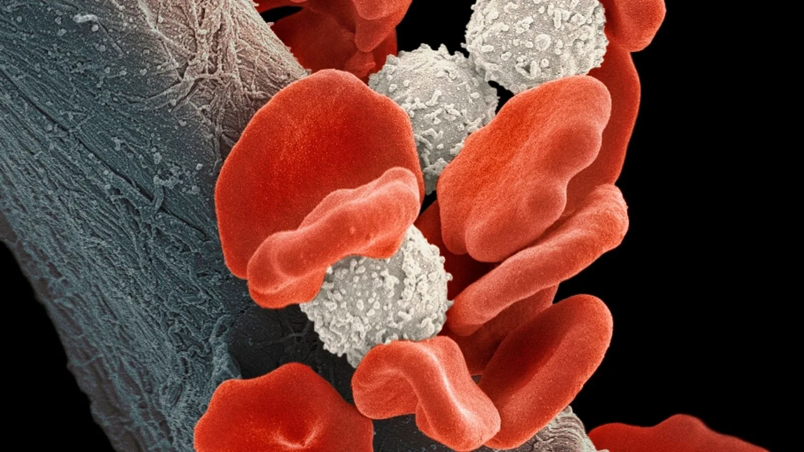 Infection Prevention in Blood Cancer Patients: Risks and Protective Measures Hematolojik Kanserlerde Enfeksiyondan Korunma Yollari
