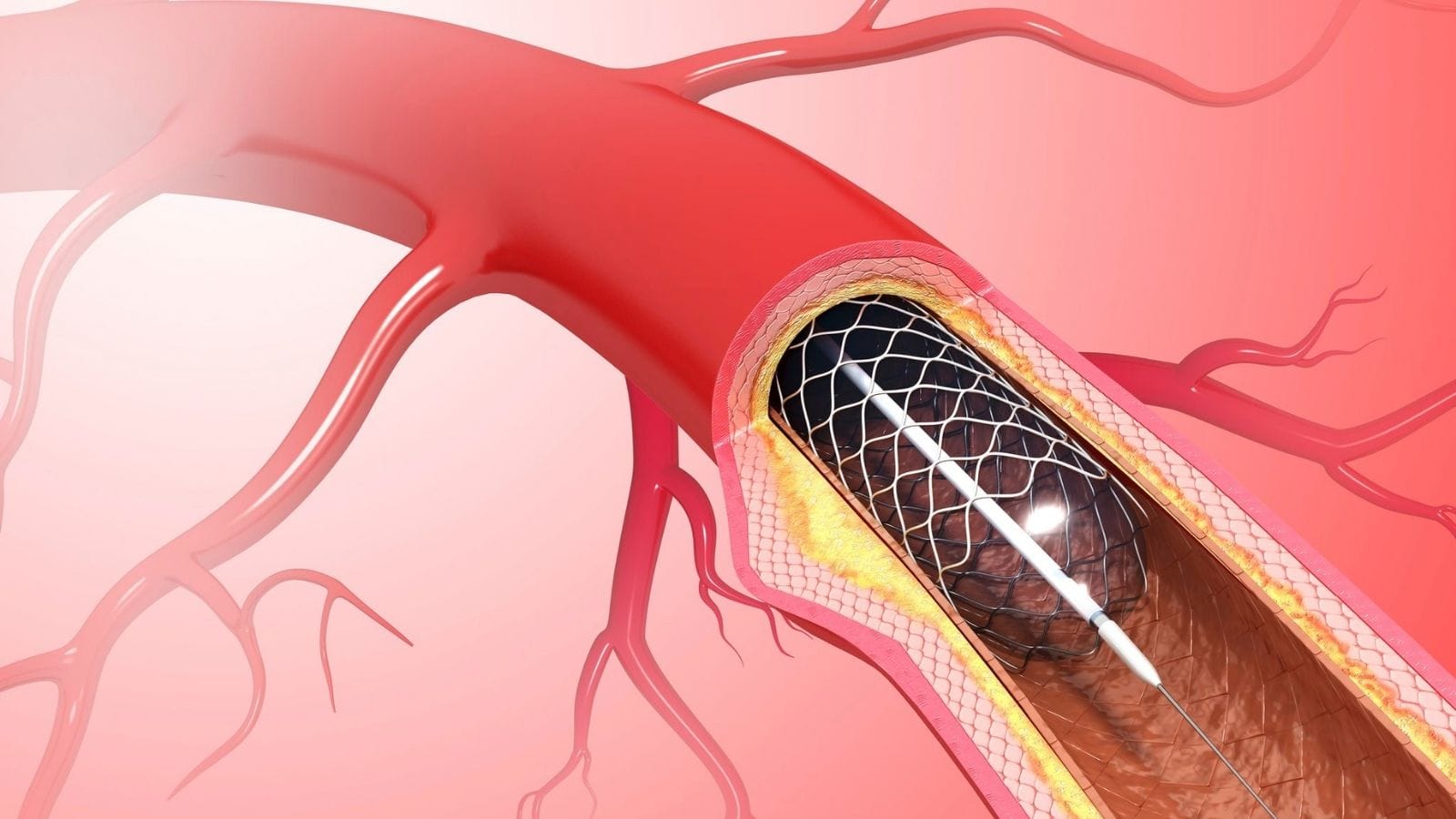 Angioplasty Anjiyoplasti Nedir Nasil Yapilir Angioplasty Anjiyoplasti Nedir Nasil Yapilir
