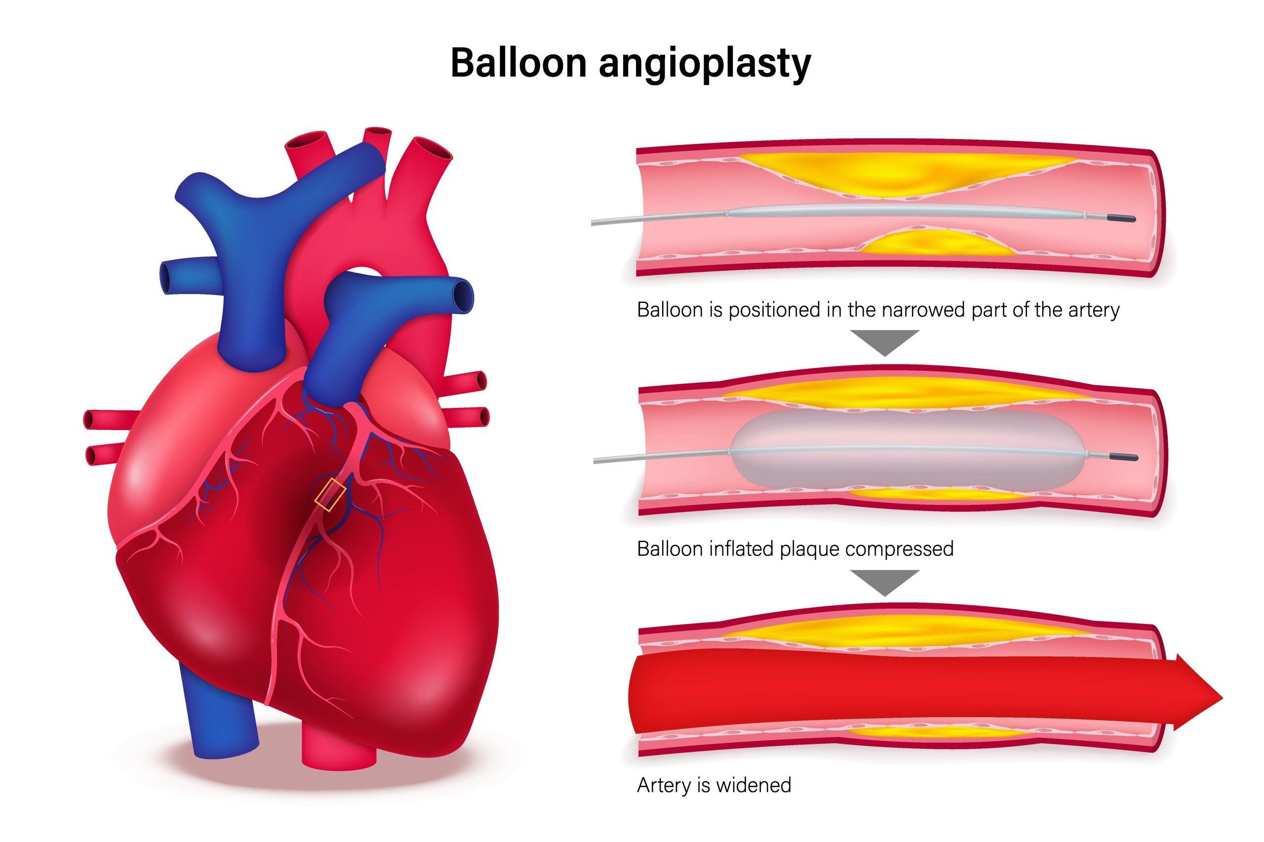 Balon Anjiyoplasti Nedir? Riskleri, Fiyatları ve Süreci Balon Anjiyoplasti scaled Balon Anjiyoplastinin uygulama aşamaları