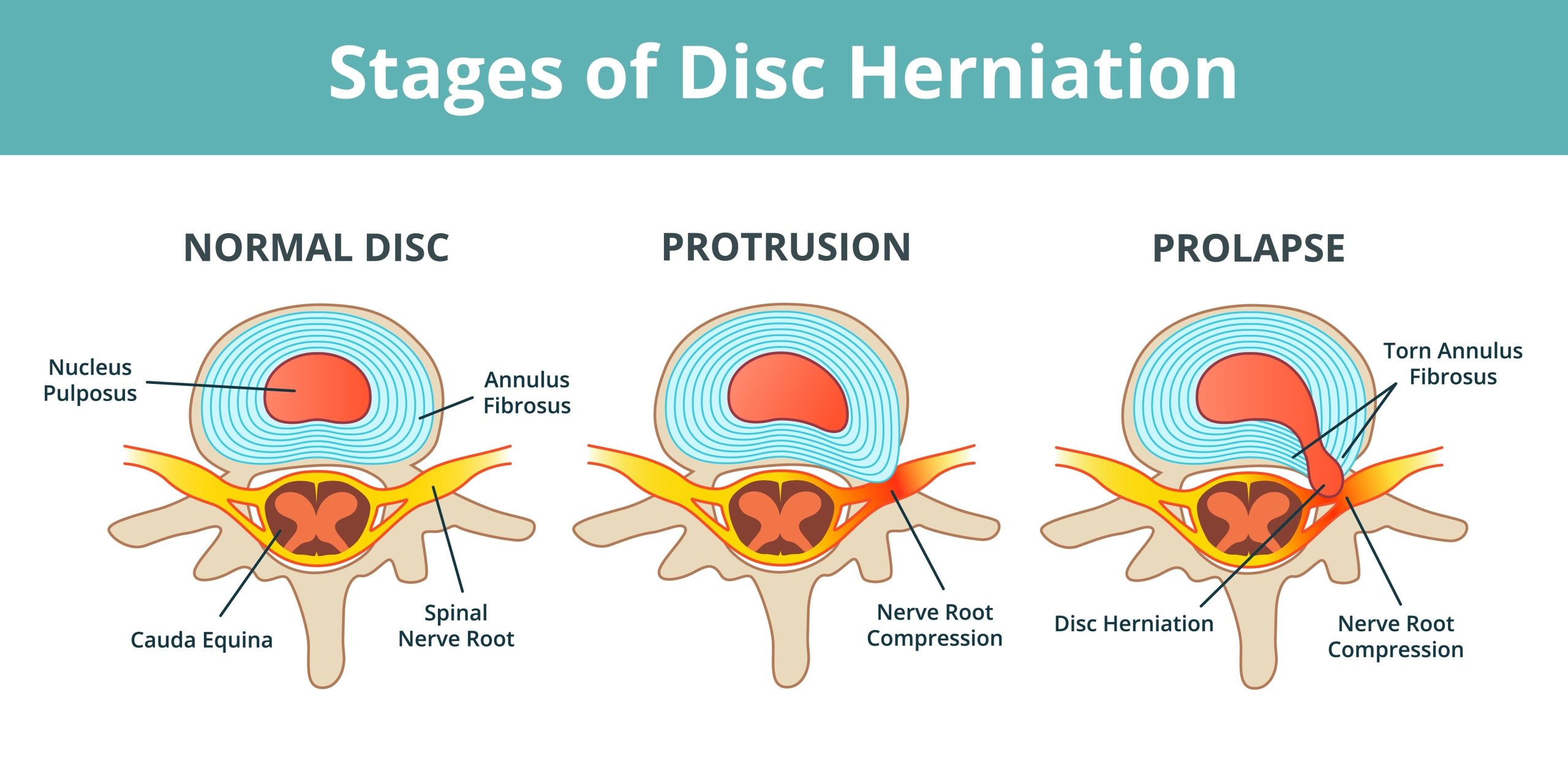 Disk Protrüzyonu Disk Protruzyonunu gosteren illustrasyon scaled Disk Protrüzyonunu gösteren illüstrasyon