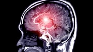 Anevrizma Nedir? Beyin Anevrizması Belirtileri Nelerdir? Anevrizma Nedir Beyin Anevrizmasi Belirtileri Nelerdir Anevrizma Nedir? Beyin Anevrizması Belirtileri Nelerdir? Anevrizma Nedir Beyin Anevrizmasi Belirtileri Nelerdir