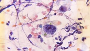 Neoplasm: Definition, Types, Symptoms and Diagnosis Neoplazma Nedir Neoplazma Nasil Ortaya Cikarilir