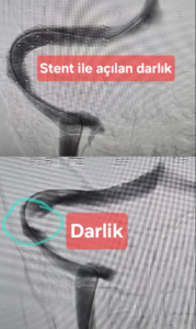 Vakalar beyin toplardamar stentleme