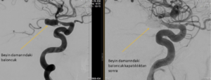 Vakalar kanamis beyin anevrizmasi koil tedavisi