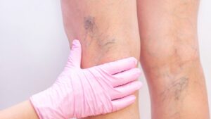 Non-Surgical Treatment for Blocked Leg Arteries Ameliyatsiz Bacak Damar Tikanikligi Tedavisi